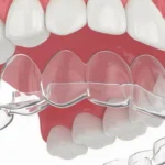 Що таке Елайнери для зубів? Інноваційний підхід до корекції усмішки