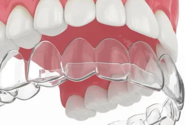 Що таке Елайнери для зубів? Інноваційний підхід до корекції усмішки