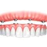 Сучасна імплантація без компромісів: технології, яким довіряють