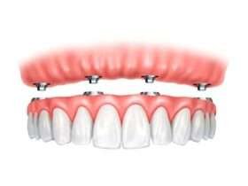 Сучасна імплантація без компромісів: технології, яким довіряють