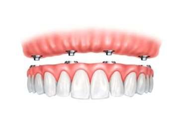 Сучасна імплантація без компромісів: технології, яким довіряють